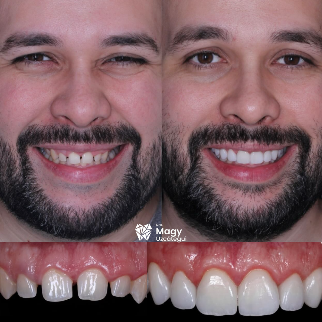 DISEÑO DE SONRISA 1